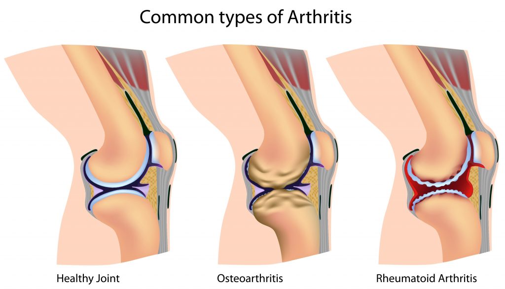 common-types-of-arthritis